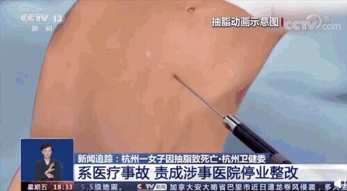 别轻易尝试！女子抽脂后去世，医生提醒→-抽脂能吗