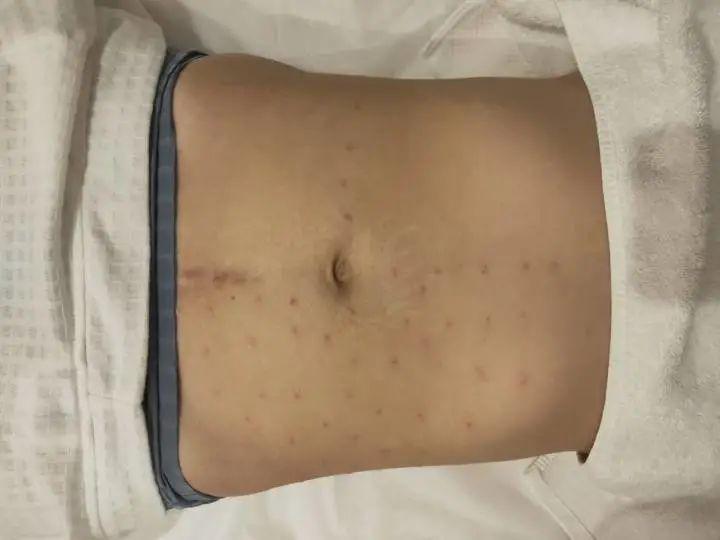 杭州妈妈填充胸部，一台1万元手术两次“转手”成15.8万元！还做坏了......