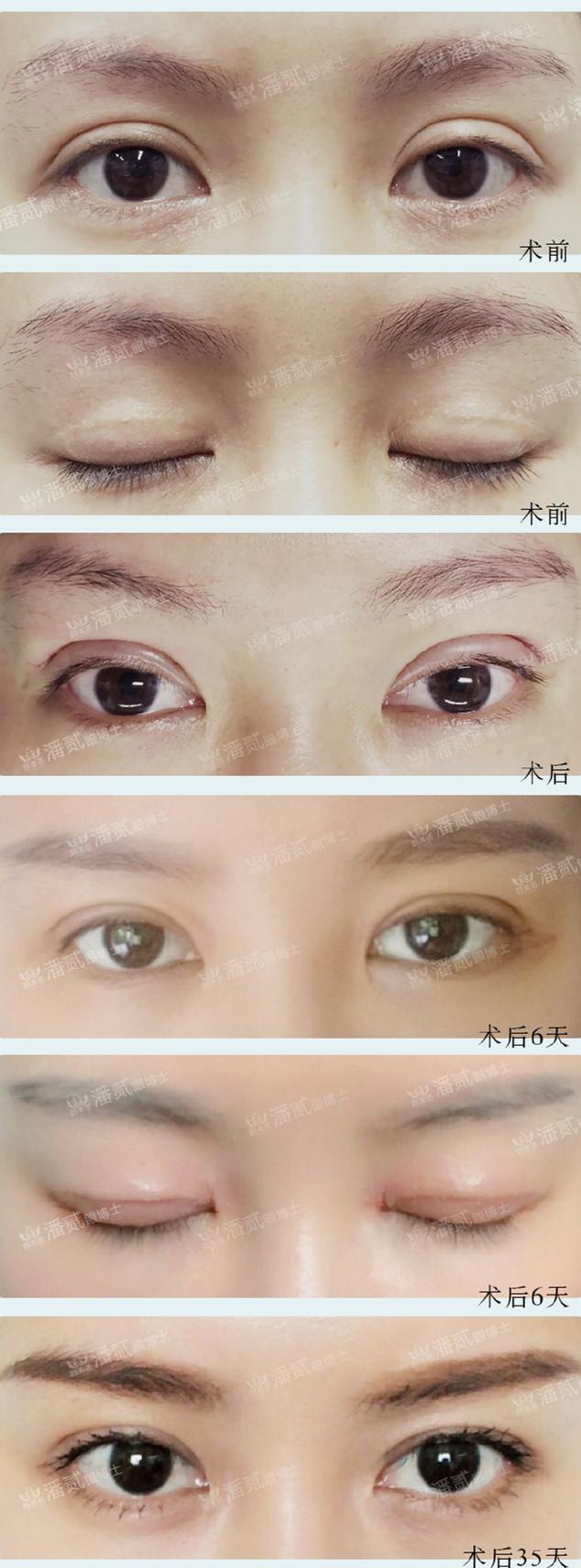 双眼皮修复：5大特征证明你割的双眼皮失败了，别再傻傻分不清楚-割了双眼皮眼睛睁不开似的正常吗怎么办