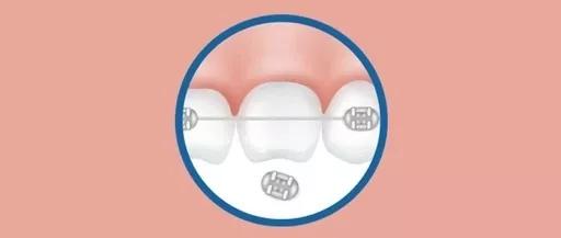 带牙套的朋友，你们有托槽掉落的情况吗？矫正牙齿钢丝脱出来了怎么办