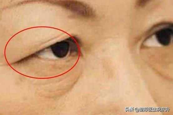 上眼皮松弛，要做手术“去皮、提上去“？听听医生怎么说-双眼皮下垂做手术多少钱