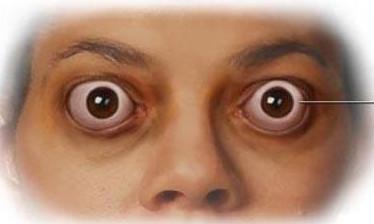 想割双眼皮？禁忌症先了解一下！什么人不适合做双眼皮手术？-割双眼皮的要求
