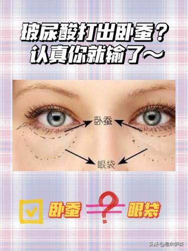 玻尿酸打出卧蚕？认真你就输了-玻尿酸卧蚕填充大概多少钱一次