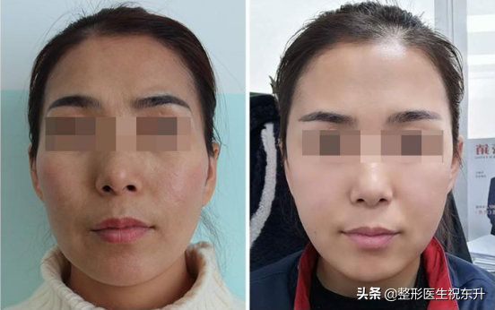 想做全脸脂肪填充，担心脸肿的太明显，大概几天能消肿？-抽脂脸部多久可以恢复