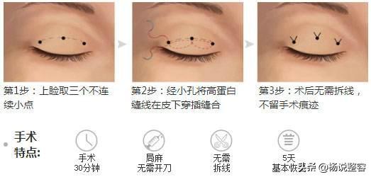 埋线双眼皮的原理是什么，又有什么优缺点呢？-埋线做双眼皮后左边眼睛很卡