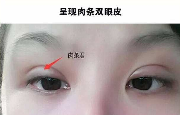 双眼皮肉条明显怎么办？不想多走弯路看这里-全切双眼皮大肉条多久才能消