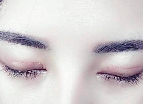 双眼皮瘢痕好明显！究竟是什么原因？-疤痕体质割的双眼皮会怎么样