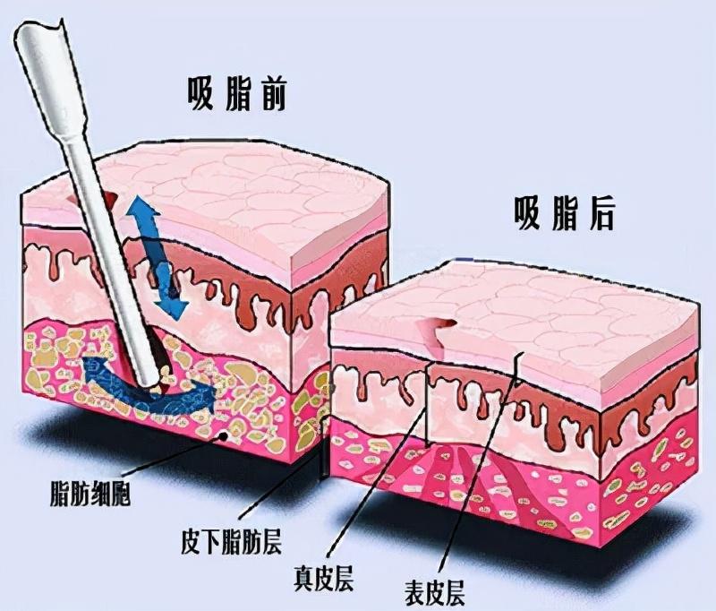 任何部位肥胖都可以通过吸脂改善吗？