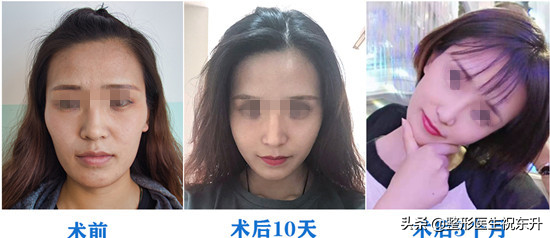 自体脂肪填充成活率“80%以上”，确定不是“说大话”？-自体脂肪填充减肥会瘦掉吗？
