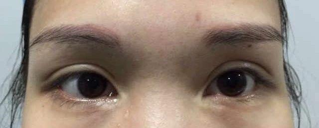 请别再怀疑潘贰做双眼皮手术切肌肉了，希望这是我最后一次澄清-割完双眼皮眼周围发黄怎么消除