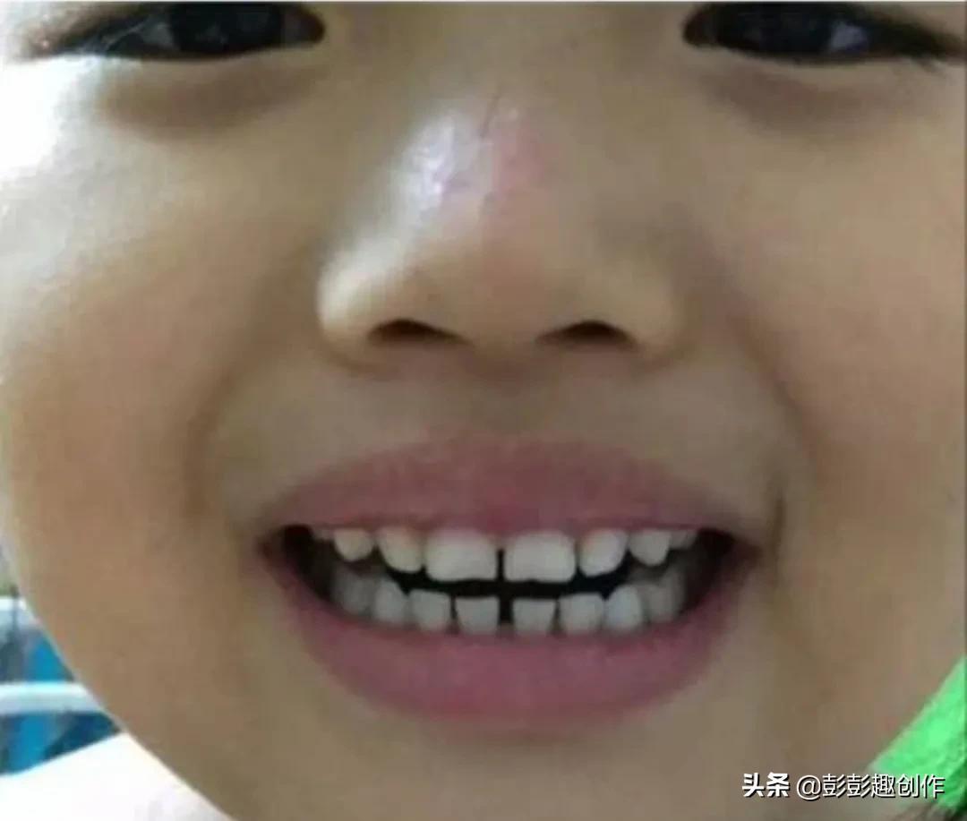 牙齿矫正那些糟心事，戴两年牙套成龅牙，要想不龅再拔牙-儿童龅牙矫正需要拔牙吗