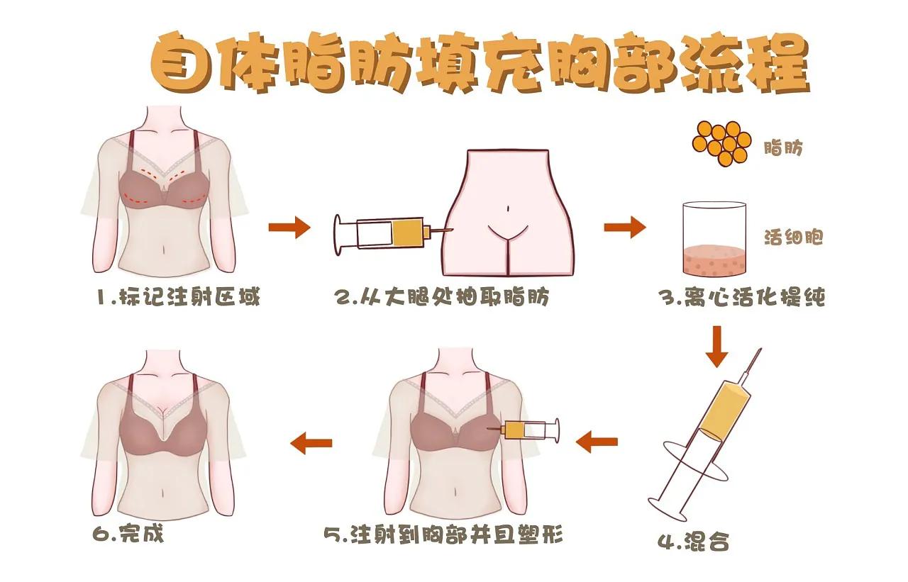 自体脂肪隆胸与假体隆胸的优缺点你们都知道吗？