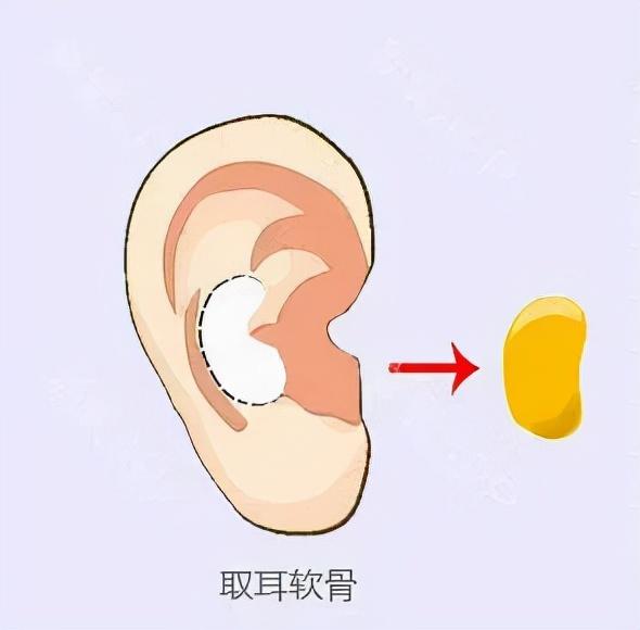 耳软骨用于隆鼻的话会被完全吸收吗？-耳软骨修复隆鼻