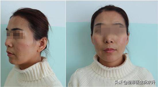 脸上没肉真是“太吃亏“了，做完脂肪填充，脸意外好看-美容手术脂肪填充