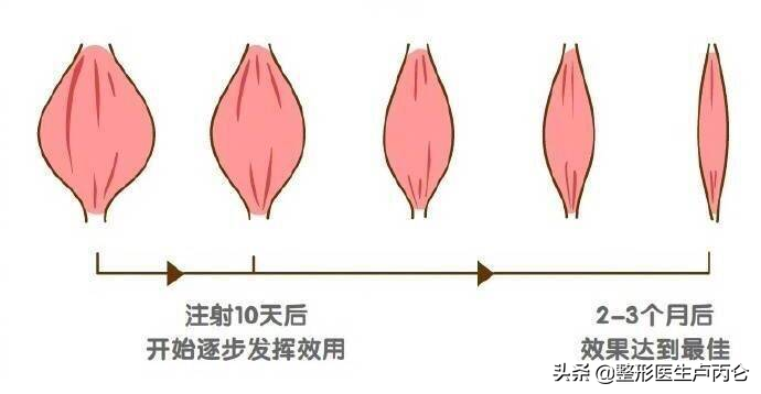 肉毒素注射咬肌后出现一侧咬肌突出是什么原因？怎么处理？打完瘦脸针脸不对称怎么办