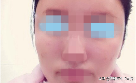 自体脂肪被称为“软黄金”，不过填充的风险也不少-自身脂肪填充的