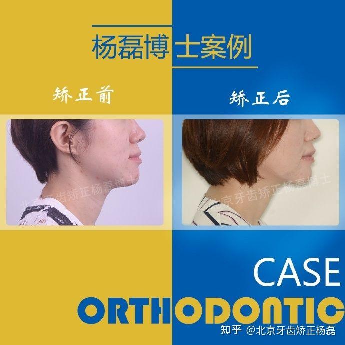 北京牙齿矫正：「反颌案例」-个别牙反颌怎么矫正多少钱