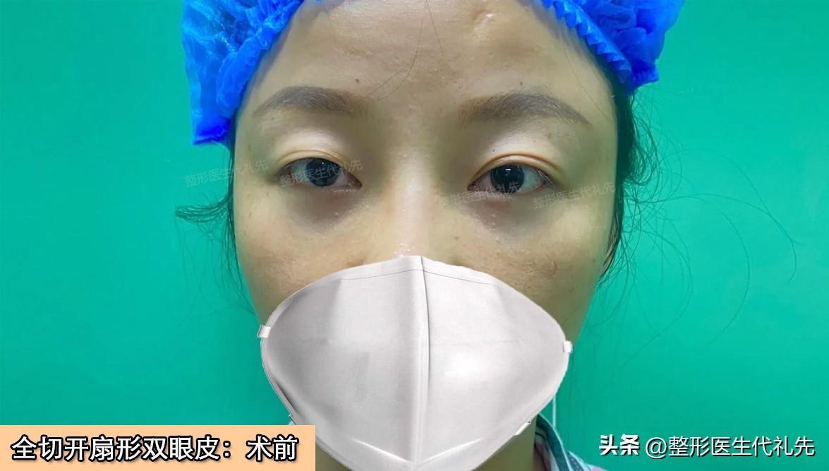 43岁忍受不了上眼睑眼皮松弛，变形，来北京做全切自然开扇双眼皮-不想做双眼皮但想让眼皮变薄