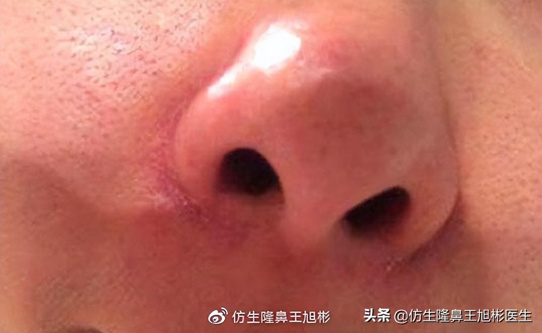 隆鼻整形的风险、危害和后遗症-鼻翼缩小和隆鼻哪个风险高