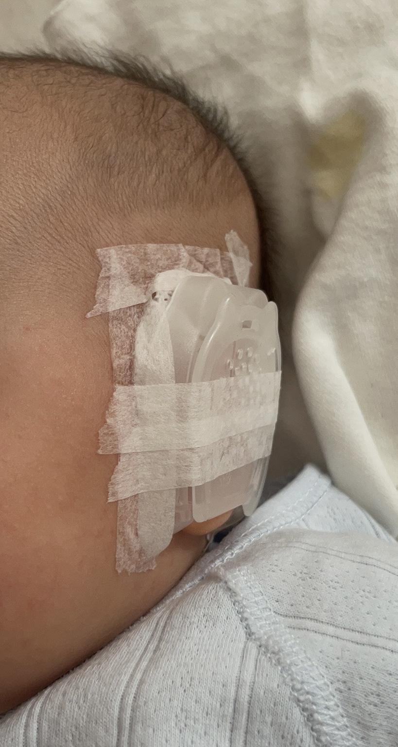 塑料模具加胶带卖上万！婴儿耳廓畸形，新手父母买万元矫形器被疑智商税-畸形牙齿矫正器