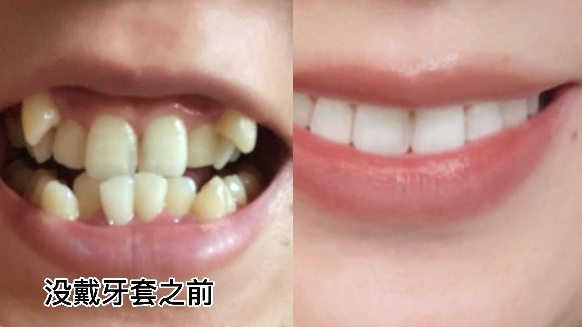25岁女生记录矫正牙齿，从参差不齐到自信微笑，坚持2年花7000元-矫正牙齿大约要多少钱？