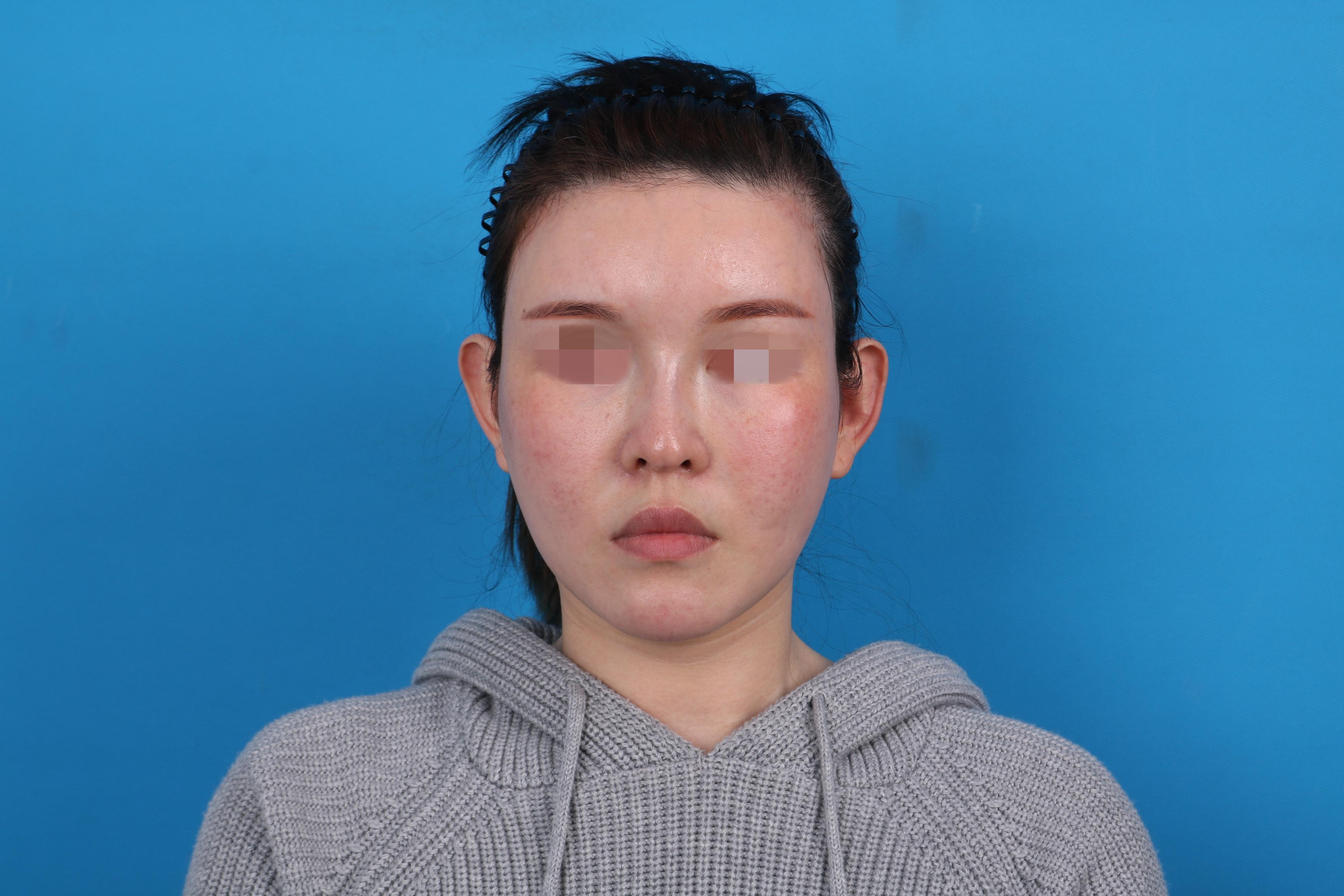 离婚后到北京做鼻修复，术后变成“富贵脸”真是捡到宝