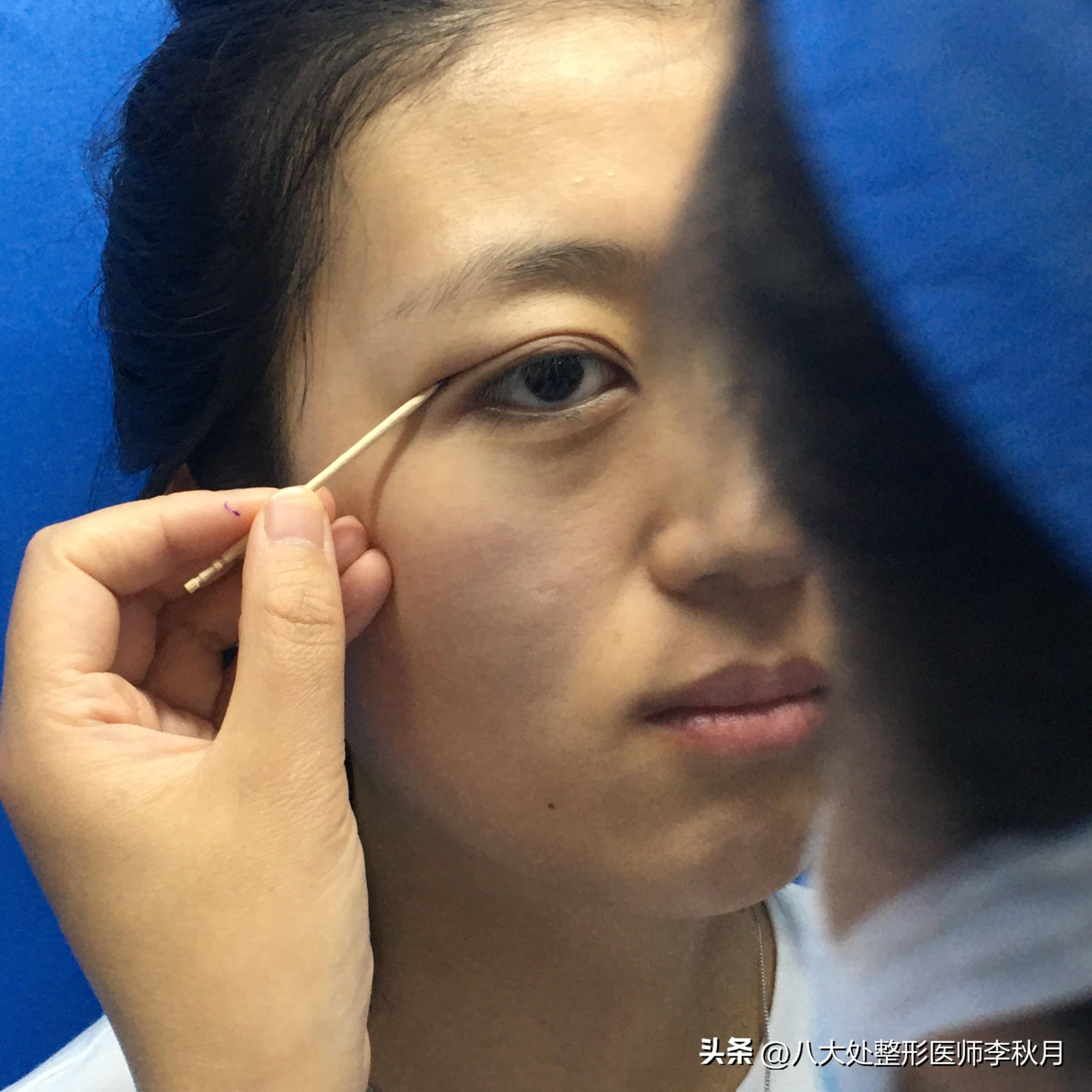 双眼皮面诊到底在面什么？-姨妈来做双眼皮会怎么样