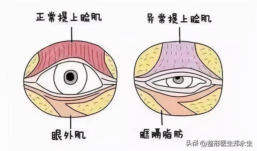 同样是割双眼皮，为什么有的人年轻了10岁，而有的人老了10岁？-割双眼皮技术什么时候有的