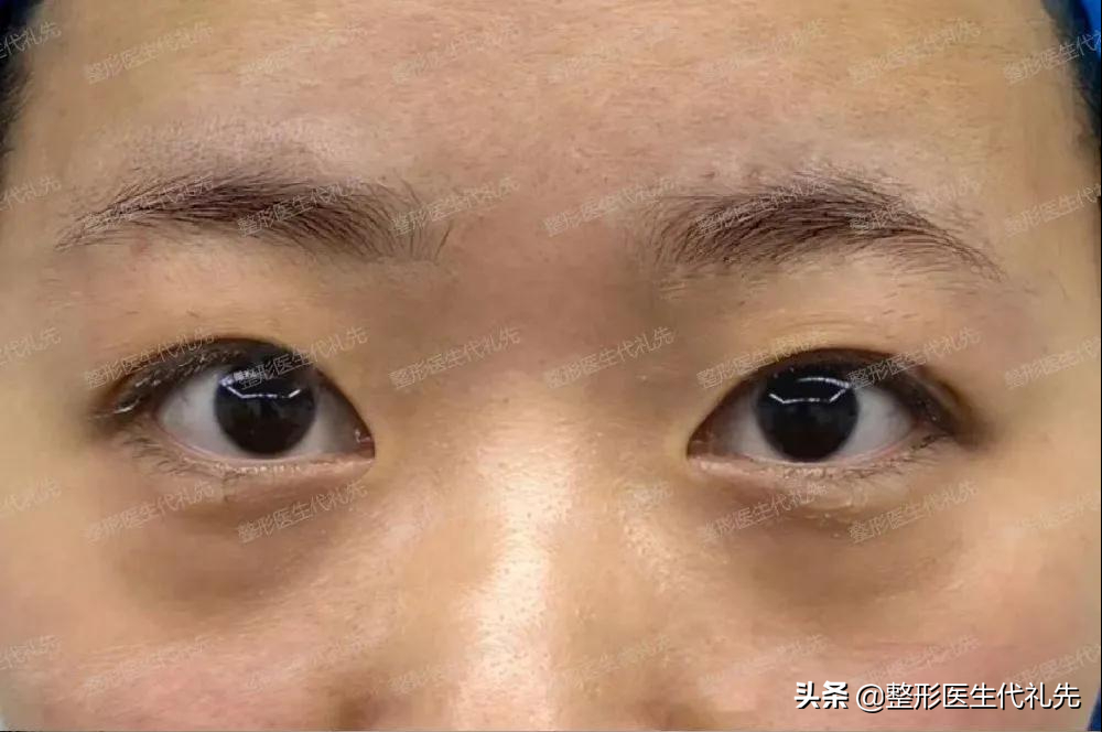 38岁女士做了开扇形自然款双眼皮，术后眼睛变大变漂亮-扇形双眼皮恢复过程