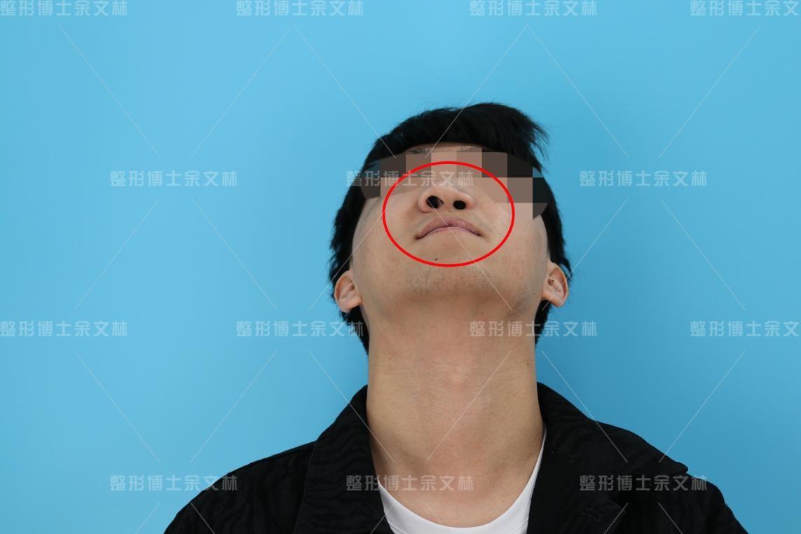 唇裂术后继发鼻畸形修复需要多长手术时间？-鼻中隔偏曲矫正手术多久恢复