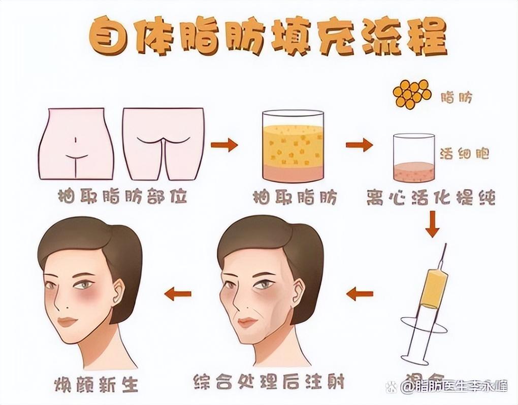 自体脂肪填充后多久能恢复？-脂肪填充可以保持几年