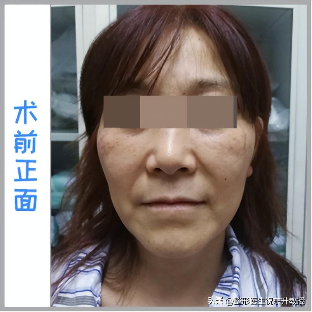 55岁把拉皮手术做了，分享我的手术经历，以及常见的问题-颧骨吸脂手术多少钱一次