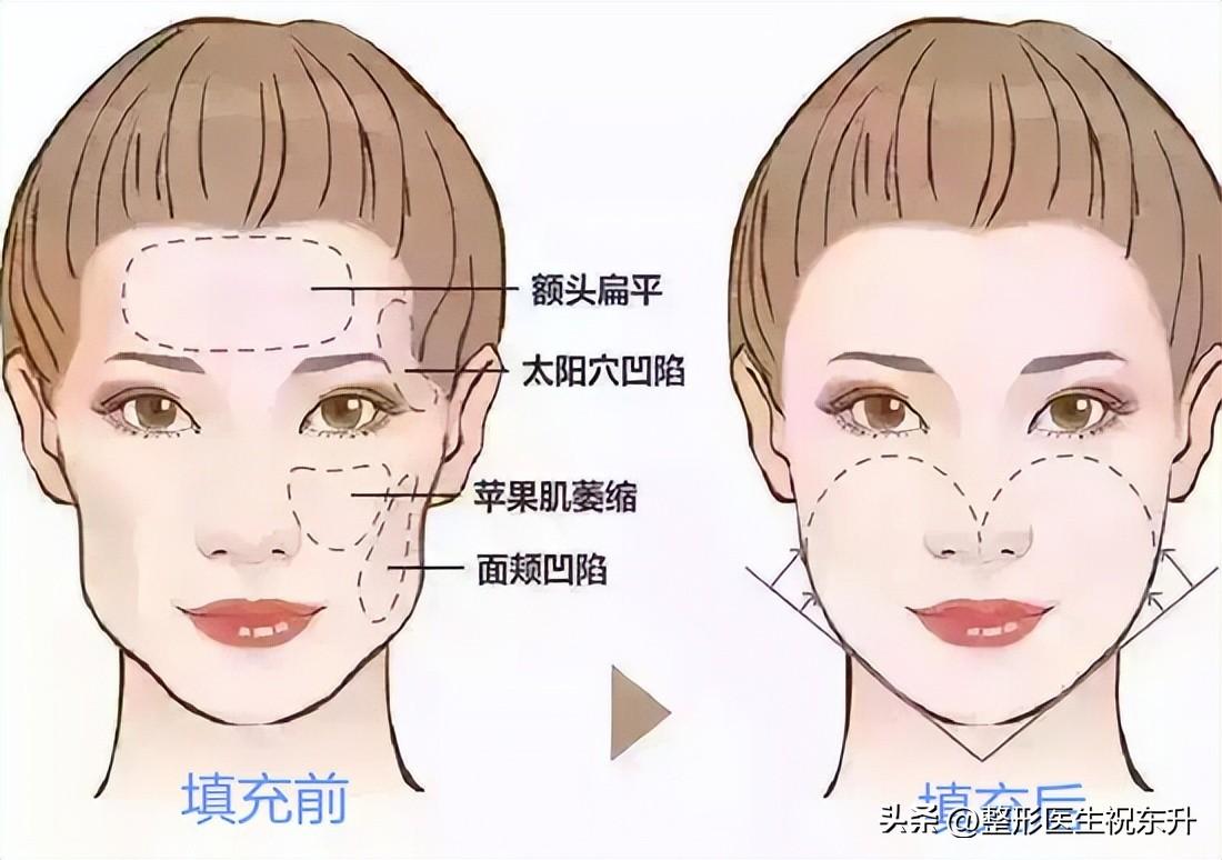 我院的医生和护士，都很喜欢“全脸自体脂肪填充”这个医美项目！-自体脂肪填充脸部手术过程