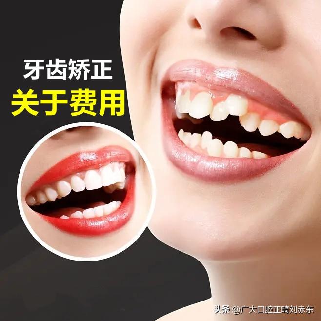 正畸需要多少钱？牙齿矫正的费用，受这四个因素影响！-多大年龄能矫正牙齿