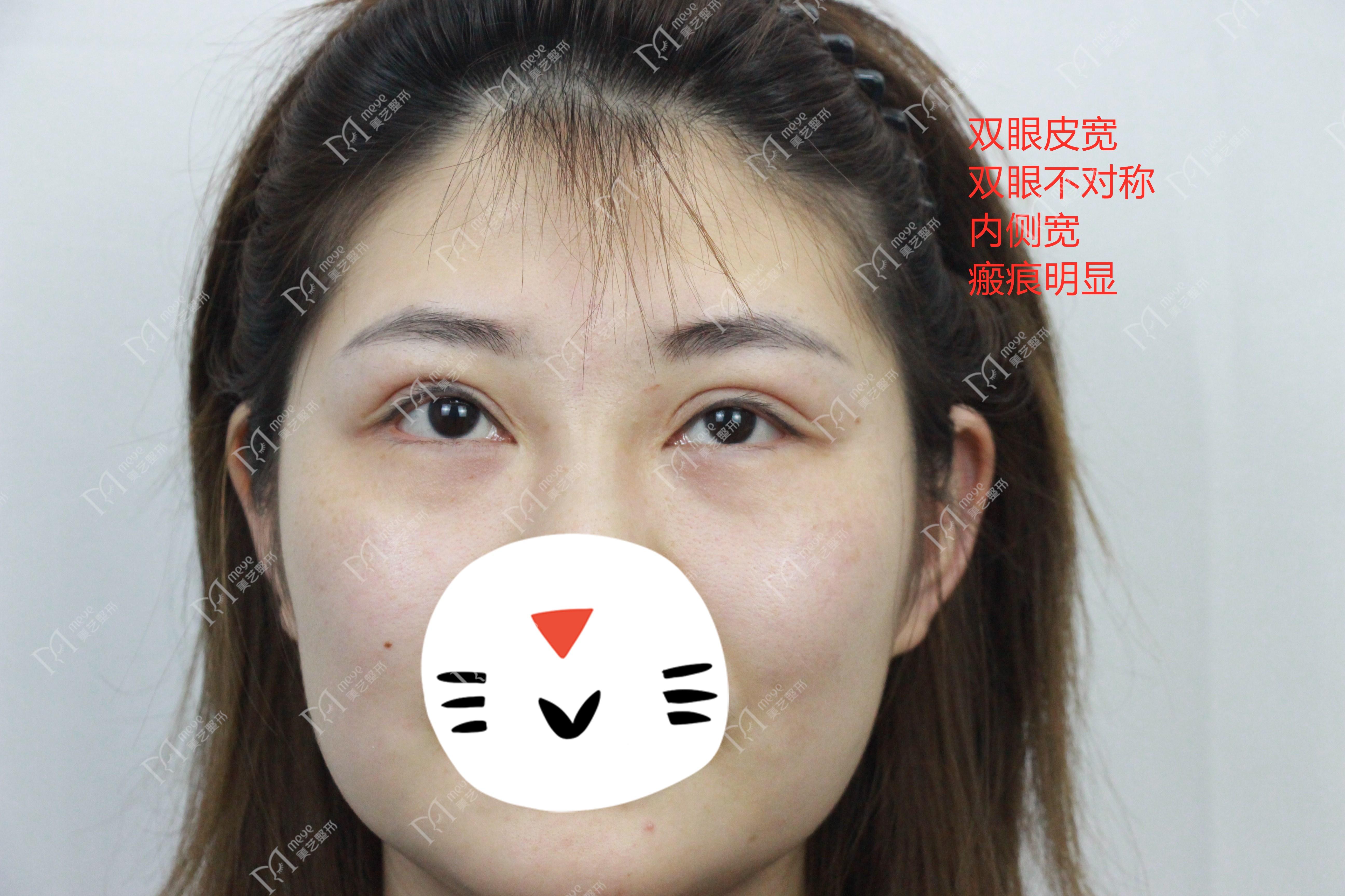双眼皮割的太宽怎么办？找有双眼皮修复经验的医生修复改善。-割双眼皮3个月肉条不消肿