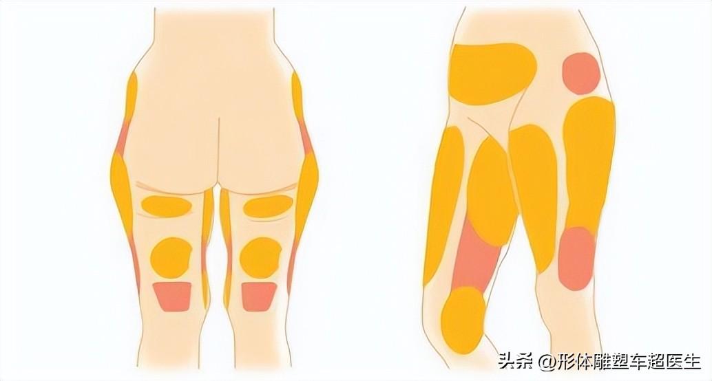 吸脂后出现凹凸不平怎么办？-抽脂腿会凹凸不平吗