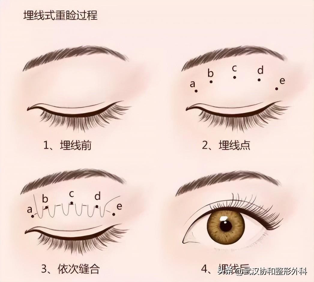 双眼皮手术快问快答-双眼皮埋线得多少钱一次