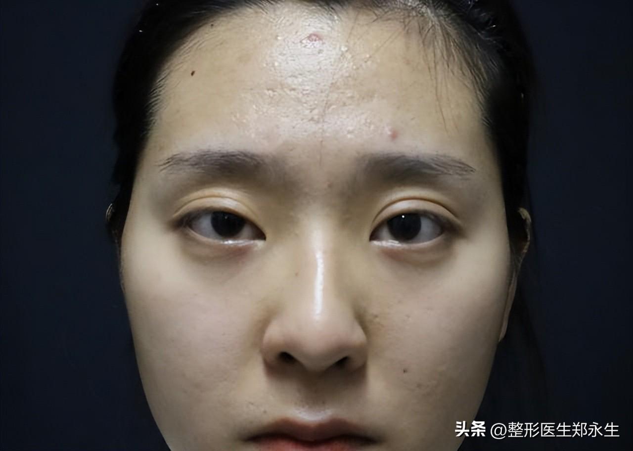 双眼皮术后出现大小眼，这是怎么回事？还能恢复正常吗？-双眼皮下垂怎么回事720P下载