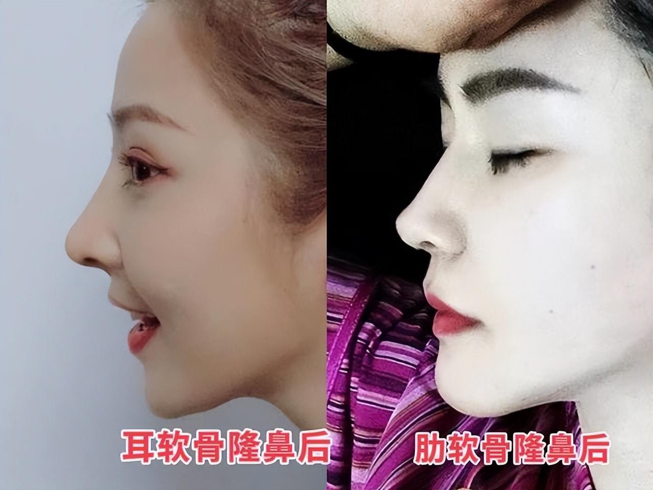 隆鼻必看！25年隆鼻医生科普：耳软骨做鼻子，比肋软骨更自然吗？-耳软骨隆鼻注意事项和饮食