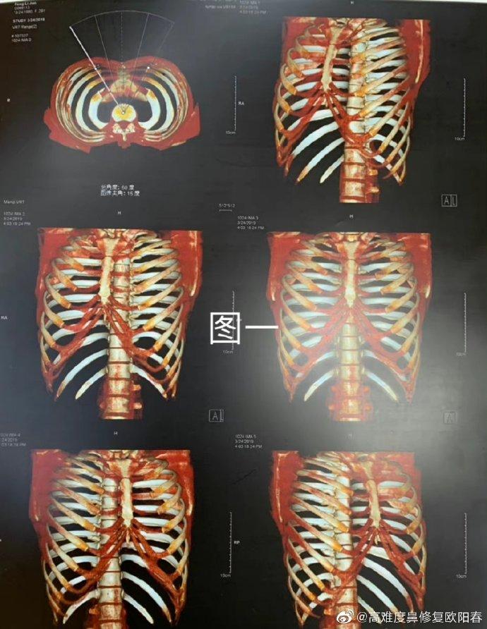 做全肋和半肋软骨鼻整形做三维CT有什么区别？-半肋骨跟全肋骨隆鼻的区别