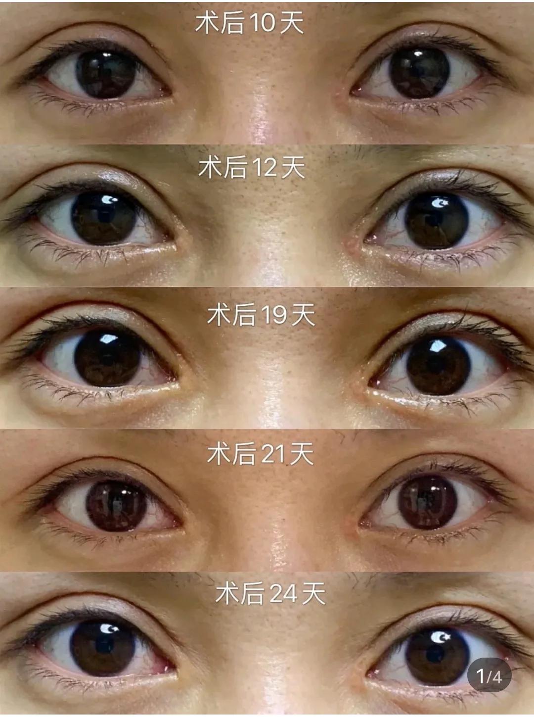 8000做了一双超级自然的双眼皮｜术后详细记录双眼皮手术面诊后就要交钱吗