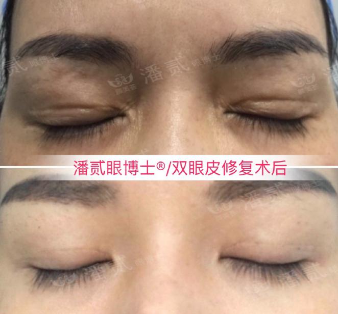 整形美容：不想被练手，割双眼皮花多少钱比较合适？-埋线便宜还是割双眼皮便宜