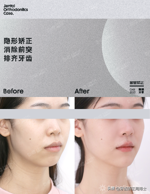 隐形矫正解决“整齐的龅牙”！2年2个月超前完成，效果超出预期-龅牙矫正