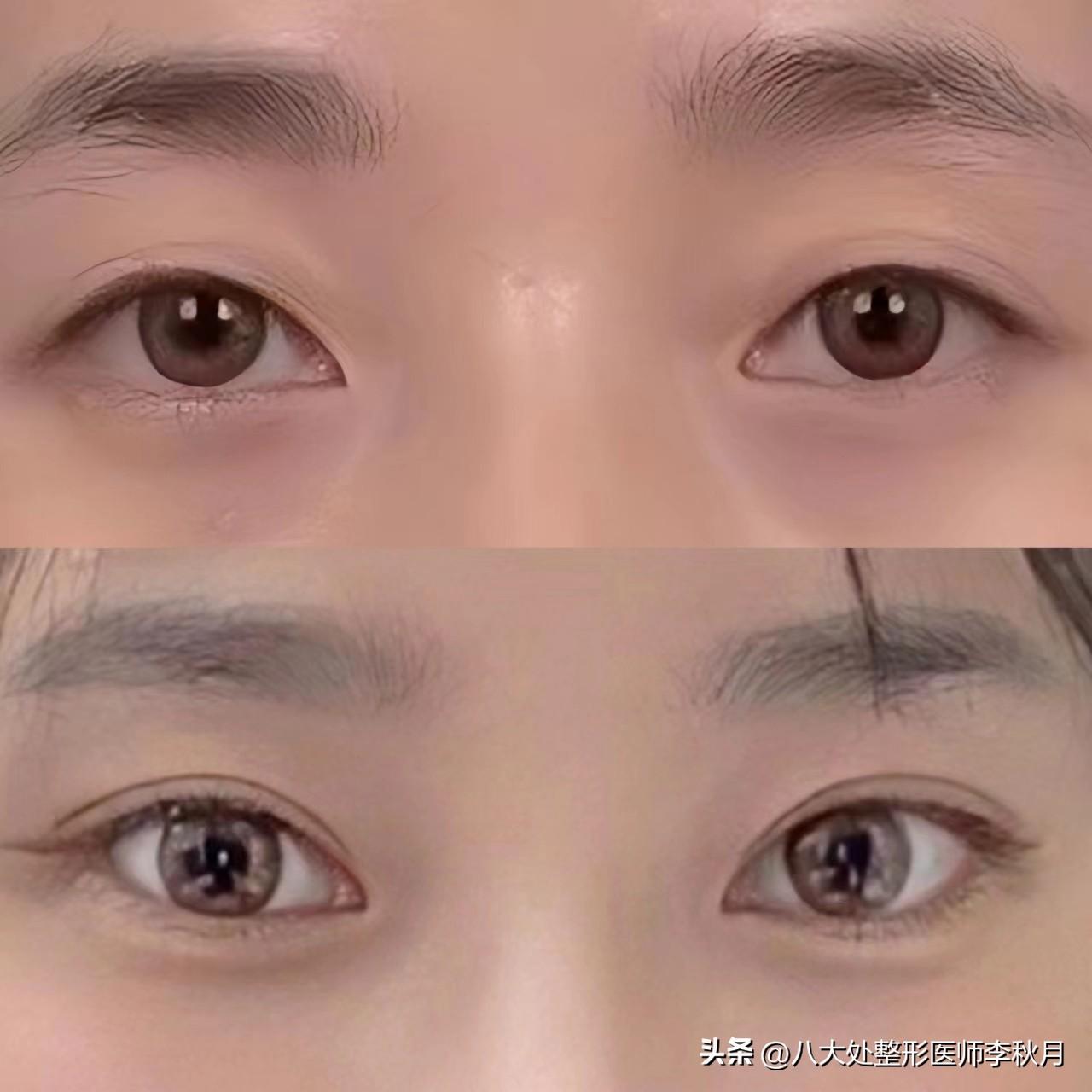 关于双眼皮手术，你想知道的都在这了！-不手术做双眼皮多少钱一次
