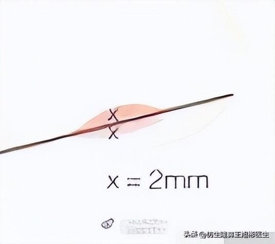 “猪鼻子”成因？鼻翼缘退缩和鼻小柱悬垂，谁的锅？-隆鼻鼻小柱凸出来