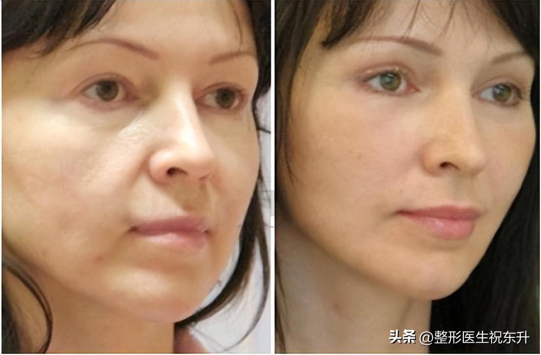 做了全脸脂肪填充后，一张脸大变样！-抽脂大腿脂肪填充脸会僵硬吗