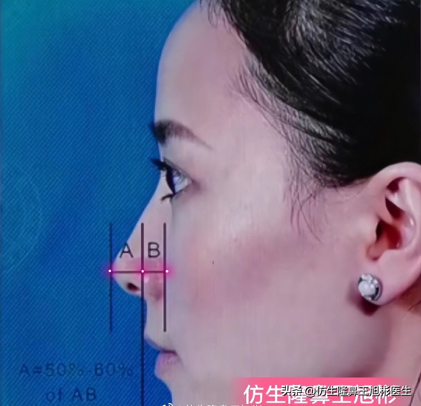 鼻部整形｜鼻头圆钝、扁趴，好看的鼻尖是这么手术来的-仿生隆鼻整形术多少钱