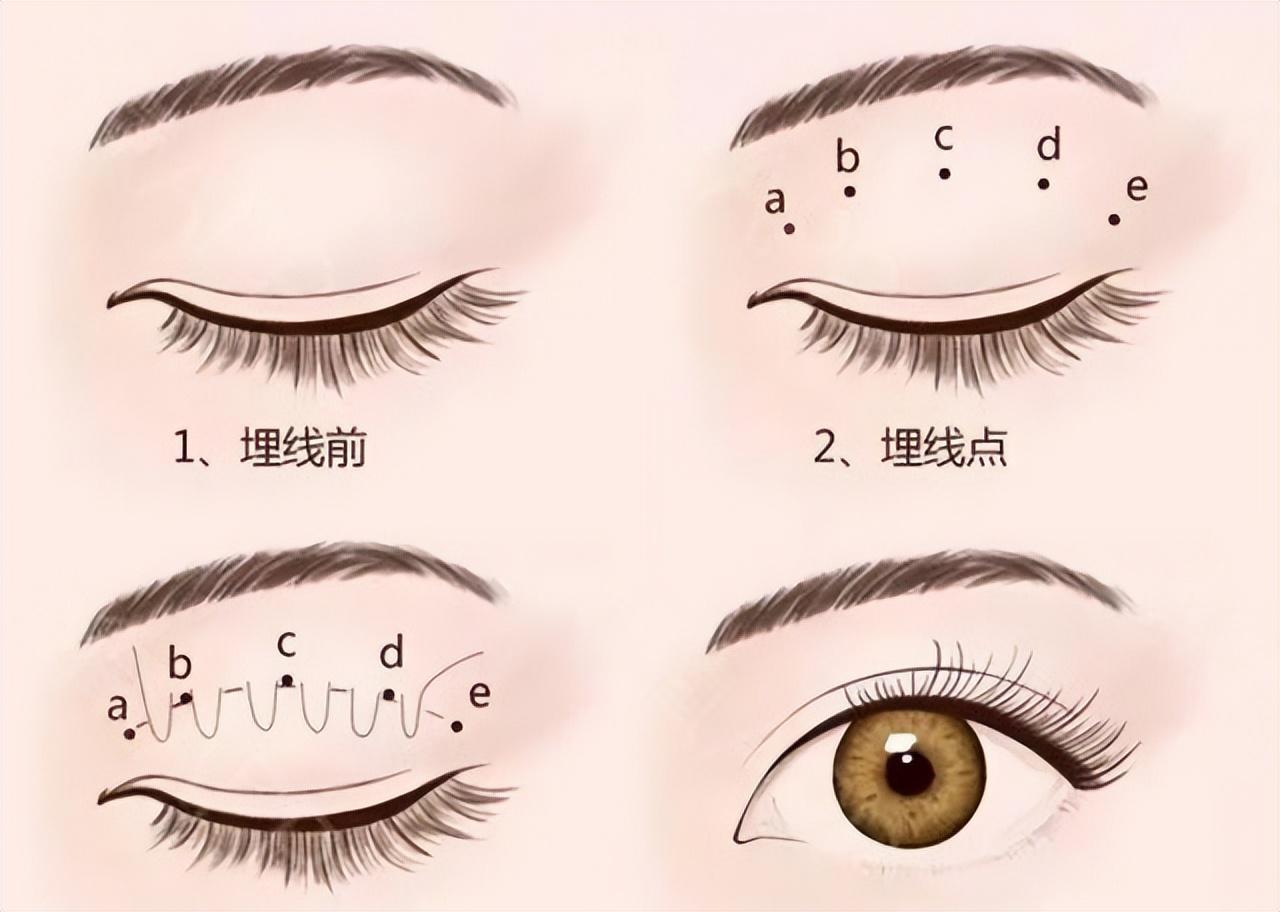 单眼皮肿眼泡为什么不适合埋线？全切效果又如何？-定点双眼皮和埋线哪个好