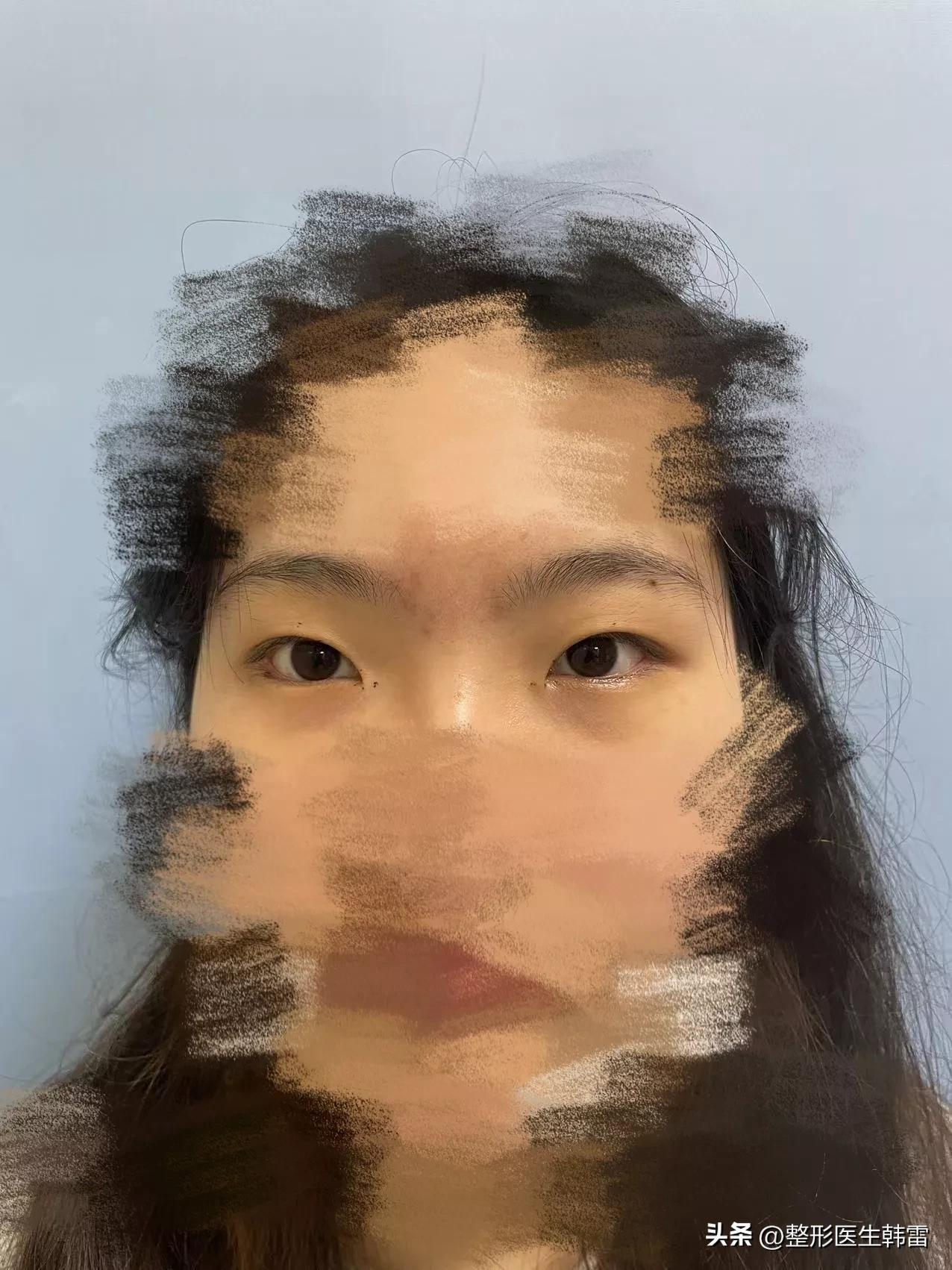 全切双眼皮好是好，可多久才能恢复自然？双眼皮全切多长时间