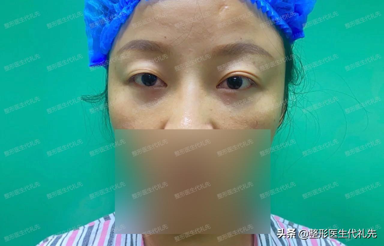 作为一名43岁埋线改全切双眼皮手术的过来人，说说我的术后感受-四十岁做埋线双眼皮能做吗女